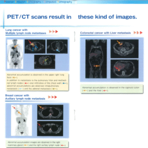 PET/CT Scans result